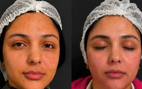 Antes e depois de uma paciente de frente: pele com menos manchas e mais uniforme