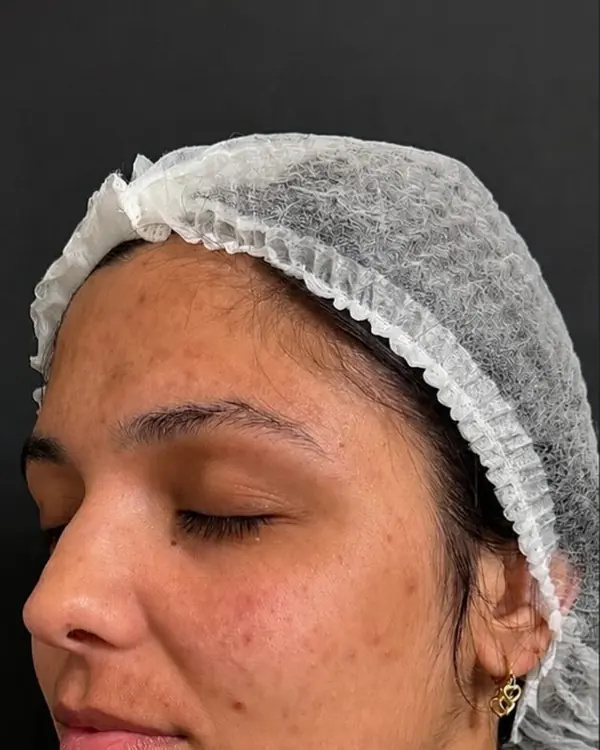 Antes: manchas espalhadas pelo rosto