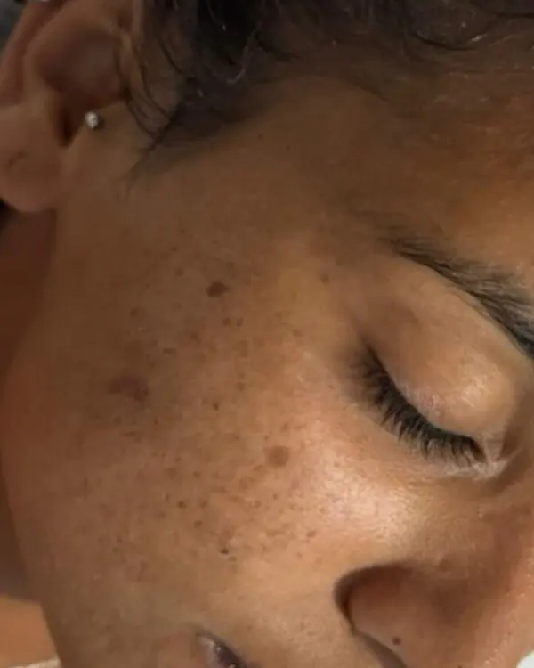 Antes: manchas de acne na bochecha