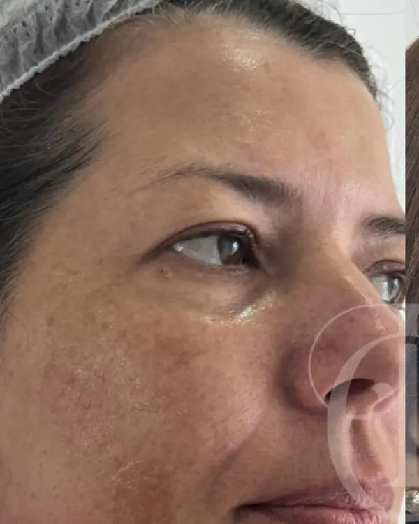 Antes: melasma marcado na maçã do rosto