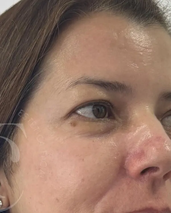 Depois: melasma mais suave