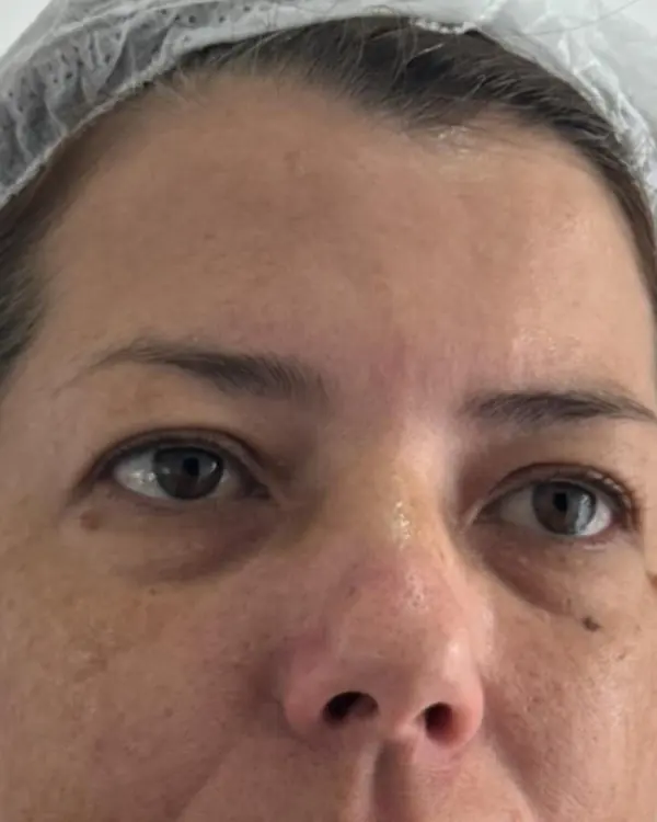 Antes: manchas de melasma de frente