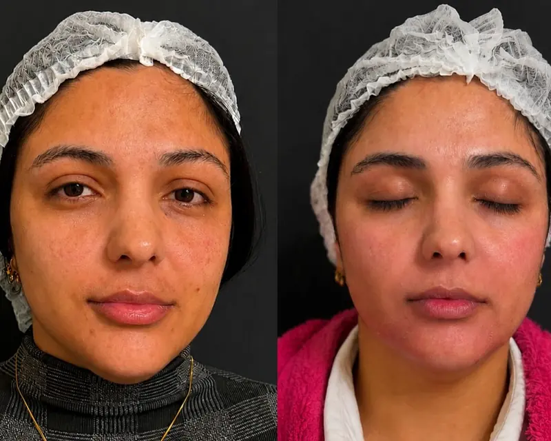 Antes e depois de frente de uma paciente: manchas mais claras depois de 3 sessões de peeling