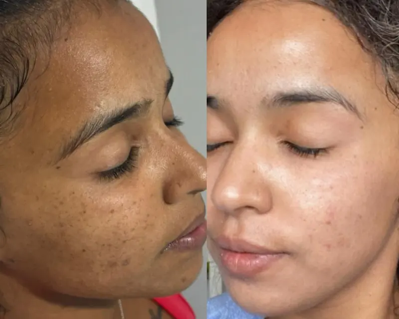 Antes e depois de perfil: manchas de acne clareadas