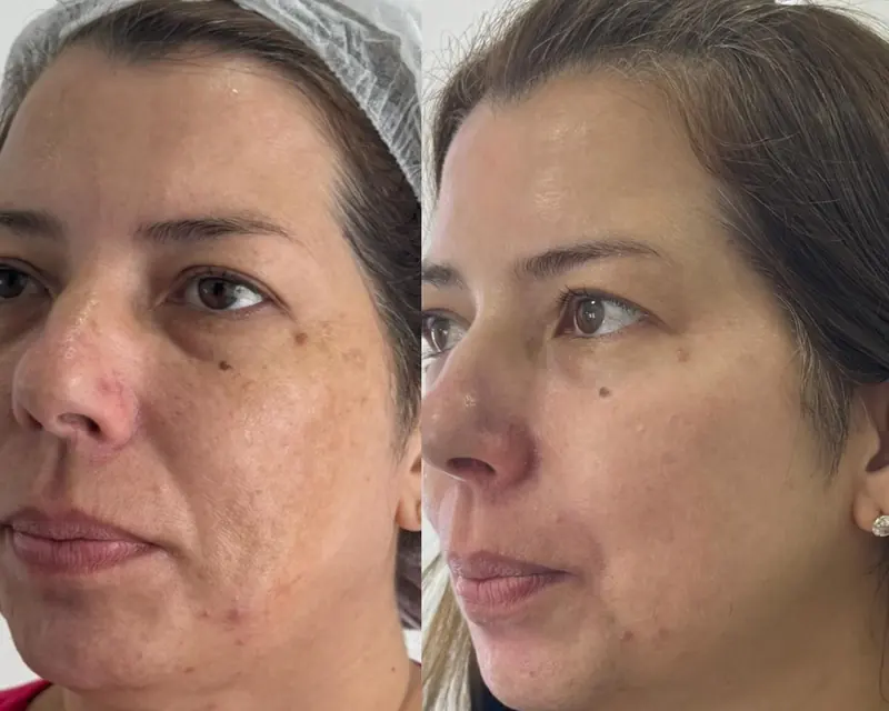 Antes e depois de uma paciente com melasma: manchas mais suaves